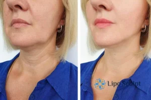 Double chin before and after Hi-Fu treatment 4 Book your double chin treatment Leicestershire today! We are here to help!