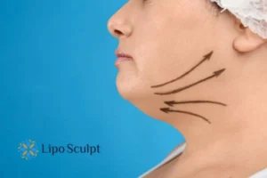 Double chin before and after Hi-Fu treatment 3 Boost your confidence with a Double chin treatment Leicestershire