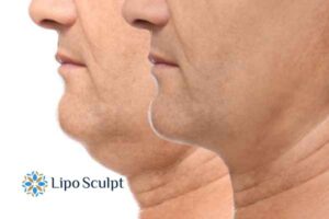 Double chin before and after Hi-Fu treatment 2 Double chin treatment Leicestershire from Lipo Sculpt - feel more confident today!