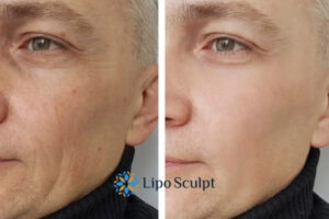 How to Fight Aging Symptoms 3 Fight Aging Symptoms Leicestershire With HIFU and Morpheus8 Today!