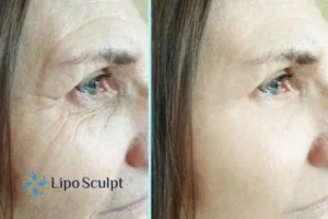How to Fight Aging Symptoms 2 Do you want to Fight Aging Symptoms Leicestershire? Contact Lipo Sculpt today!