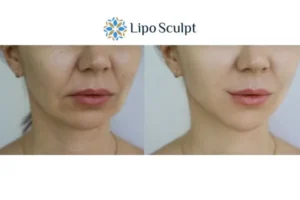 Explaining Total Skin Tightening Treatment And What It Can Do For You 2 Do you want to boost your self confidence? Give Morpheus8 Leicestershire a try today!
