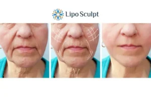 Explaining Total Skin Tightening Treatment And What It Can Do For You 3 Boost your confidence with Morpheus8 Leicestershire call our team today!
