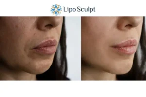 Explaining Total Skin Tightening Treatment And What It Can Do For You 4 Morpheus8 Leicestershire the best results - call our team today!
