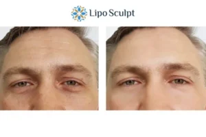 Explaining Total Skin Tightening Treatment And What It Can Do For You 6 Morpheus8 Leicestershire book in today to find out more!