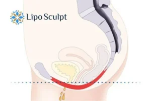 Pelvic Floor Chair Therapy 1 Pelvic Floor Chair Therapy Leicestershire to treat incontinence.
