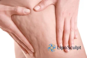 CoolSculpting for Legs: The Innovative Approach to Redefining Your Legs 5 Start your journey today book your coolsculpting treatment Leicestershire online today!