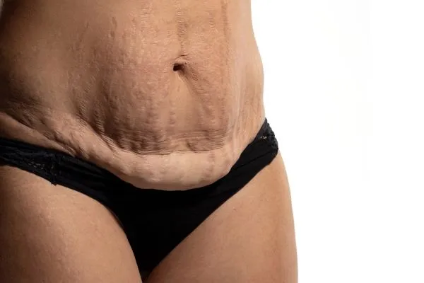 Lost the Weight but Not the Loose Skin? 1 image of womans stomach after weight loss showing loose skin Leicestershire