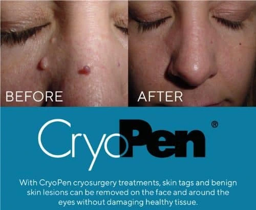 image of angiofibroma removal Leicestershire using Lipo Sculpt cryopen!
