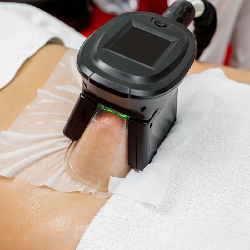 Fat Freezing treatment Leicestershire